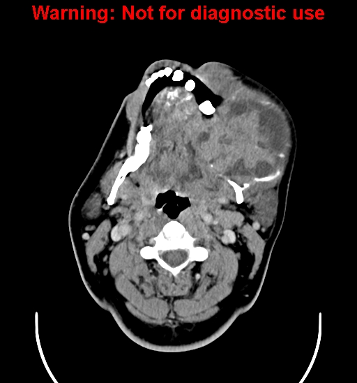 File:Ameloblastoma (Radiopaedia 33126-34164 B 9).jpg