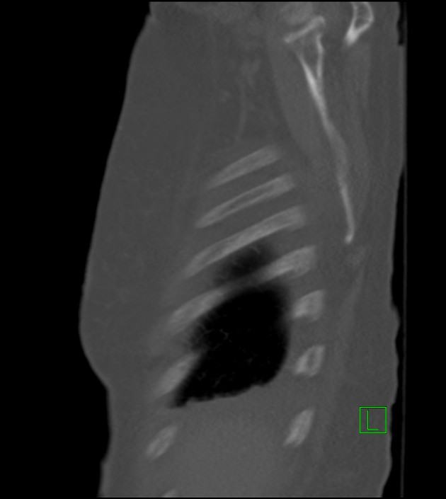 Amiodarone deposition in the liver (Radiopaedia 77587-89780 Sagittal bone window 86).jpg