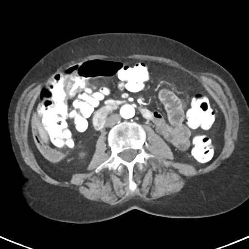 Ampullary adenocarcinoma (Radiopaedia 34013-35237 B 49).png