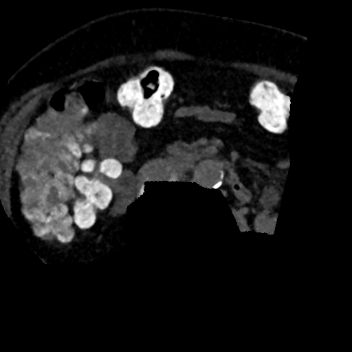 Ampullary adenocarcinoma (Radiopaedia 34013-35241 AXIAL MIPS 3-1.5 95).png