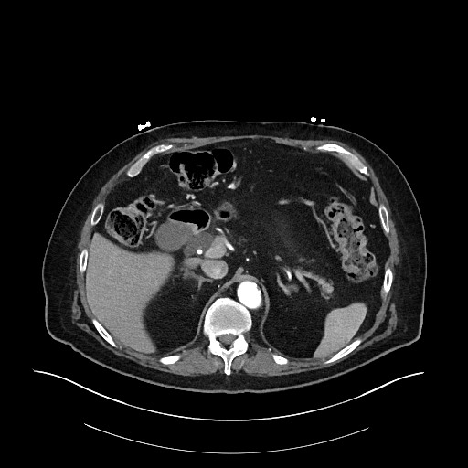 Ampullary adenocarcinoma (Radiopaedia 59373-66734 A 50).jpg