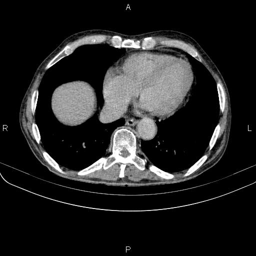 Ampullary adenocarcinoma (Radiopaedia 86093-102033 Axial C+ delayed 6).jpg