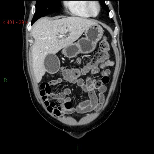 Ampullary carcinoma (Radiopaedia 56396-63056 E 28).jpg