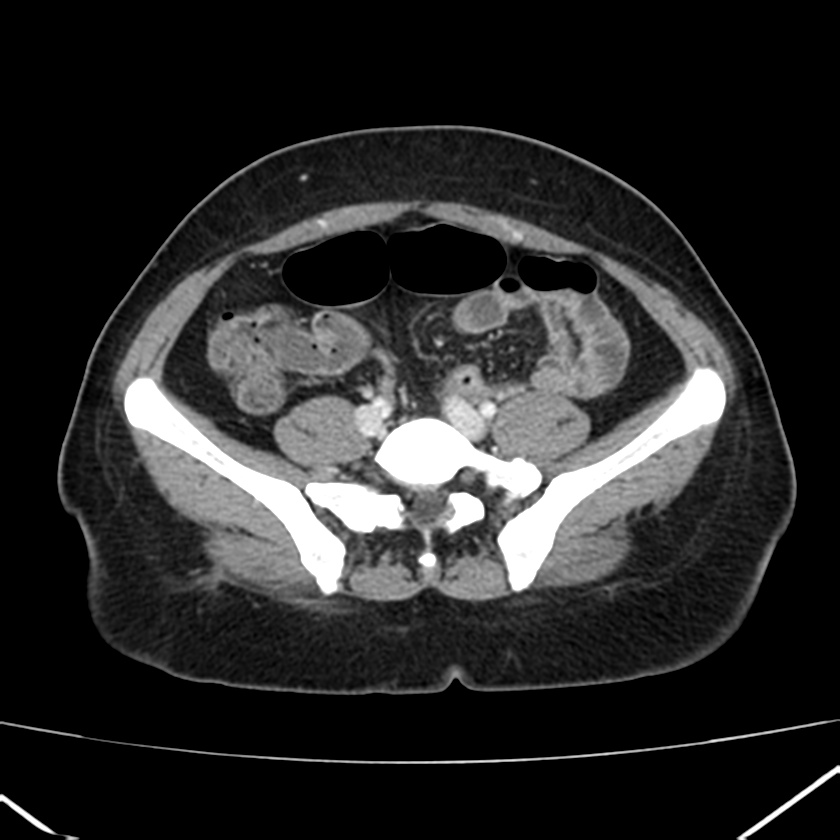 Ampullary tumor (Radiopaedia 22787-22816 C 48).jpg