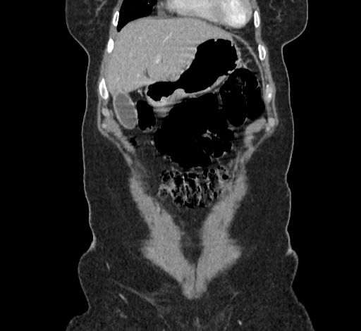 Ampullary tumor (Radiopaedia 60333-67998 B 12).jpg