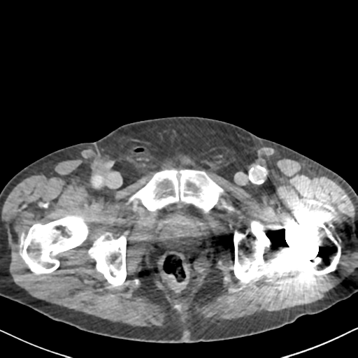 File:Amyand hernia (Radiopaedia 39300-41547 A 73).png