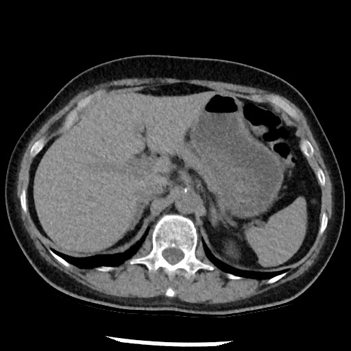 Amyloidosis - bronchial and diffuse nodular pulmonary involvement (Radiopaedia 60156-67744 Axial non-contrast 56).jpg