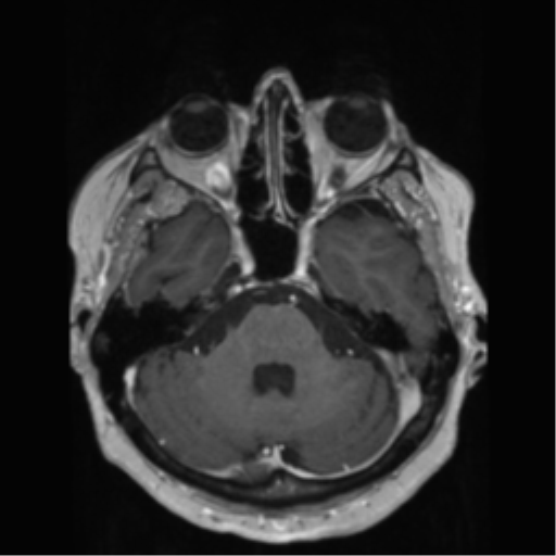 File:Anaplastic astrocytoma IDH wild-type (pseudoprogression) (Radiopaedia 42209-45278 Axial T1 C+ 52).png