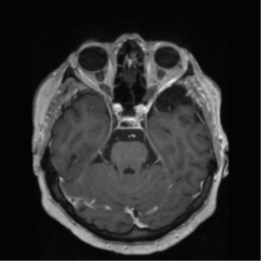File:Anaplastic astrocytoma IDH wild-type (pseudoprogression) (Radiopaedia 42209-45278 Axial T1 C+ 59).png