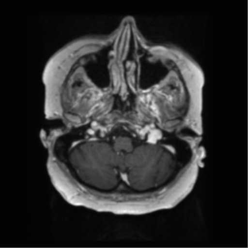 File:Anaplastic astrocytoma IDH wild-type (pseudoprogression) (Radiopaedia 42209-45279 Axial T1 C+ 26).png