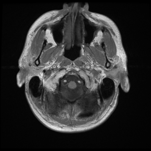File:Anaplastic meningioma with recurrence (Radiopaedia 34452-35791 Axial T1 1).png