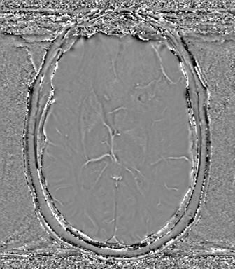 Anaplastic oligodendroglioma (Radiopaedia 83500-98599 Axial SWI - phase 45).png