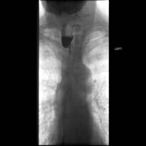 File:Anastomotic stricture post Ivor Lewis esophagectomy (Radiopaedia 47937-52715 Frontal 17).png