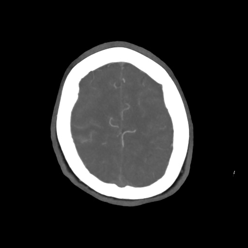 Aneursym related subarachnoid hemorrhage with hydrocephalus (Radiopaedia 45105-49084 A 54).jpg
