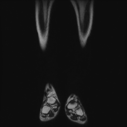 File:Aneurysmal bone cyst - tibia (Radiopaedia 22343-22367 Coronal T2 3).jpg