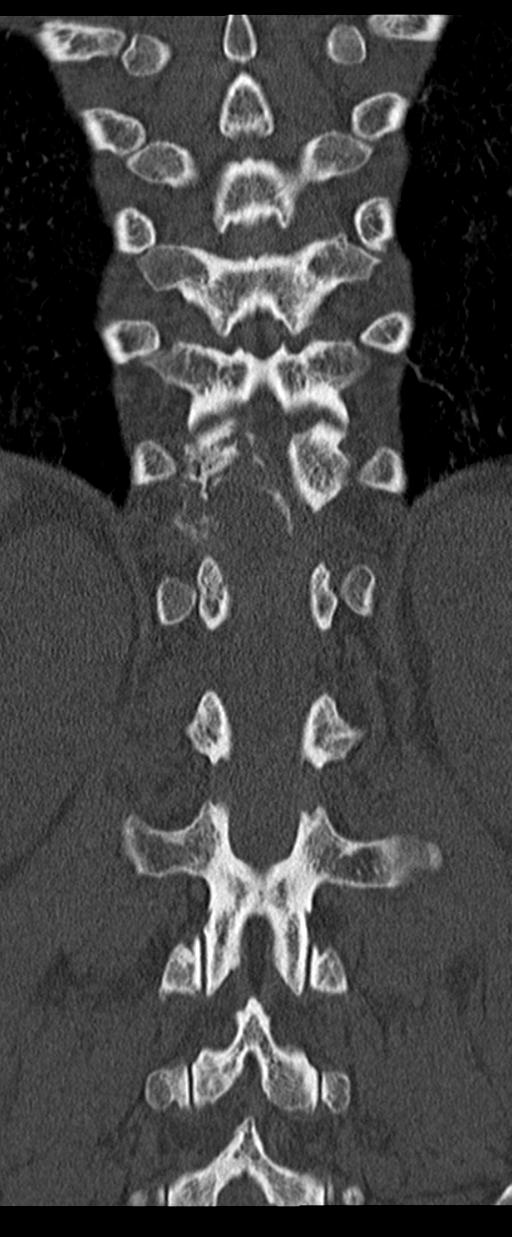 Aneurysmal bone cyst T11 (Radiopaedia 29294-29721 Coronal bone window 44).jpg