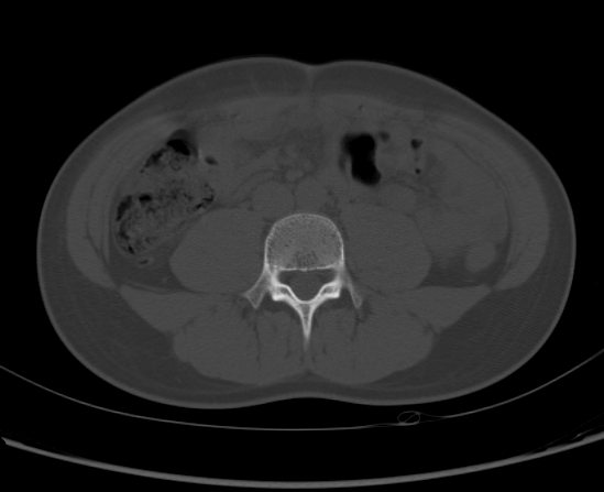 File:Aneurysmal bone cyst of ischium (Radiopaedia 25957-26094 Axial bone window 1).png