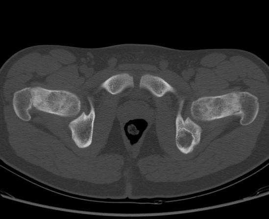 File:Aneurysmal bone cyst of ischium (Radiopaedia 25957-26094 Axial bone window 65).png