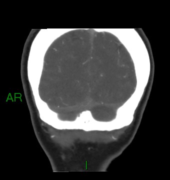 Aneurysmal subarachnoid hemorrhage with intra-axial extension (Radiopaedia 84371-99732 C 16).jpg