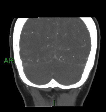 Aneurysmal subarachnoid hemorrhage with intra-axial extension (Radiopaedia 84371-99732 C 22).jpg