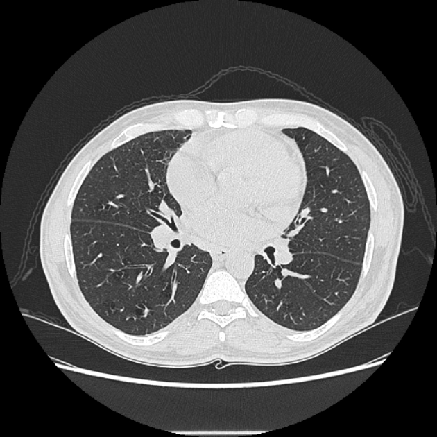 Angioinvasive aspergellosis (Radiopaedia 66995-76315 Axial lung window 27).jpg