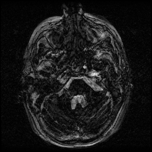 Angioinvasive aspergillosis in the pituitary fossa (Radiopaedia 39676-42010 Ax 3D FIESTA VOLUME 11).png