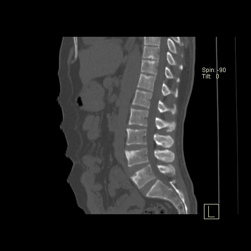 File:Ankylosing spondylitis (Radiopaedia 52728-58645 Sagittal bone window 10).jpg
