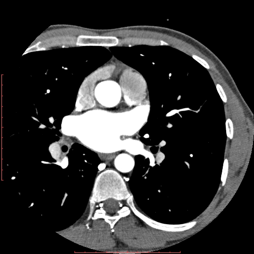 Anomalous left coronary artery from the pulmonary artery (ALCAPA) (Radiopaedia 70148-80181 A 78).jpg