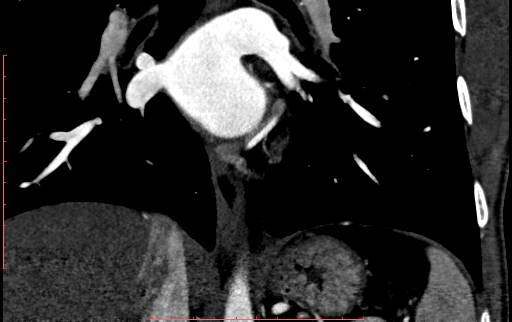 Anomalous left coronary artery from the pulmonary artery (ALCAPA) (Radiopaedia 70148-80181 B 225).jpg