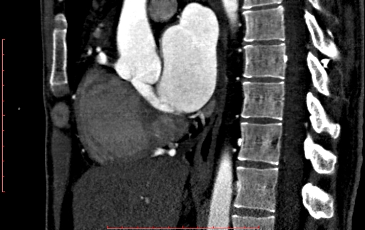File:Anomalous left coronary artery from the pulmonary artery (ALCAPA) (Radiopaedia 70148-80181 C 110).jpg