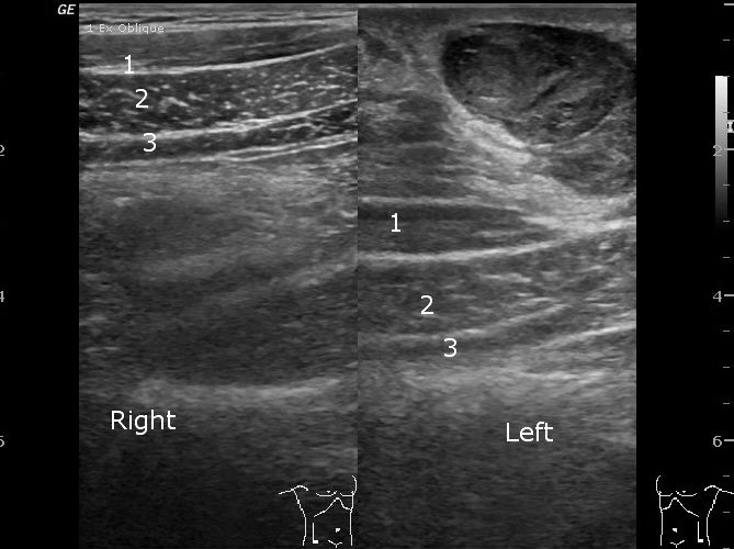 File:Anterior abdominal wall hematoma (Radiopaedia 11069-11472 E 1).jpg