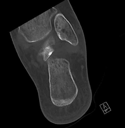 Anterior calcaneal process fracture (Radiopaedia 63353-71943 Axial bone window 113).jpg