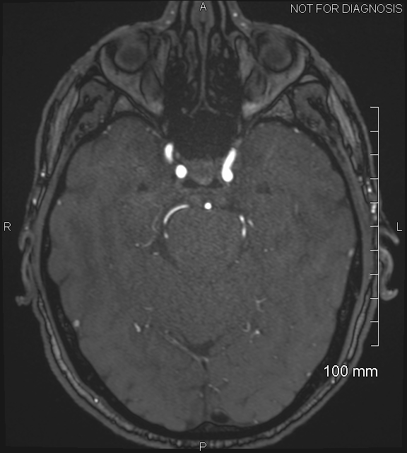 Anterior cerebral artery aneurysm (Radiopaedia 80683-94127 Axial MRA 79).jpg
