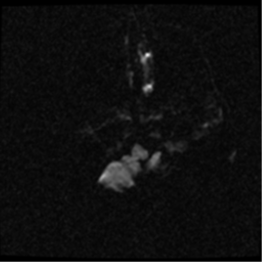 File:Anterior cerebral artery territory infarct (Radiopaedia 39327-41584 Axial DWI 1).png