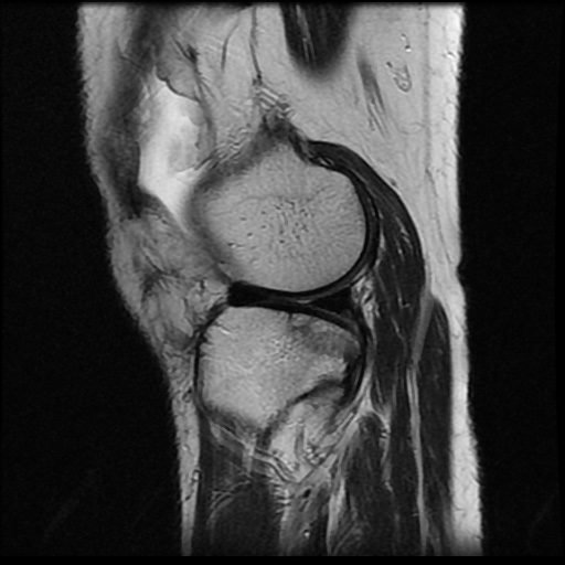 File:Anterior cruciate ligament avulsion fracture (Radiopaedia 58939-66193 Sagittal T2 6).jpg