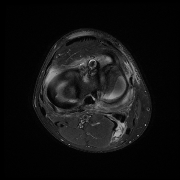File:Anterior cruciate ligament graft tear and bucket-handle tear of medial meniscus (Radiopaedia 75867-87255 Axial PD fat sat 7).jpg