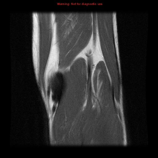 File:Anterior cruciate ligament injury - partial thickness tear (Radiopaedia 12176-12515 Coronal PD 18).jpg