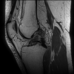 Anterior cruciate ligament rupture with Segond fracture (Radiopaedia 69043-78806 Sagittal PD 96).jpg