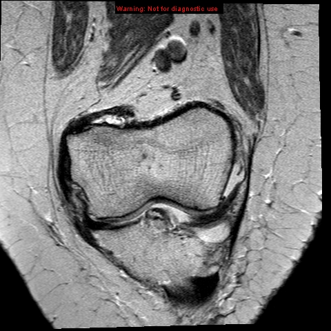 File:Anterior cruciate ligament tear (Radiopaedia 12329-12612 C 4).jpg
