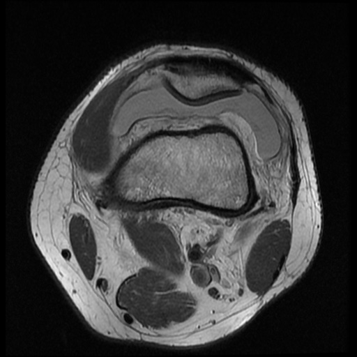 File:Anterior cruciate ligament tear (Radiopaedia 61500-69462 Axial PD 3).jpg