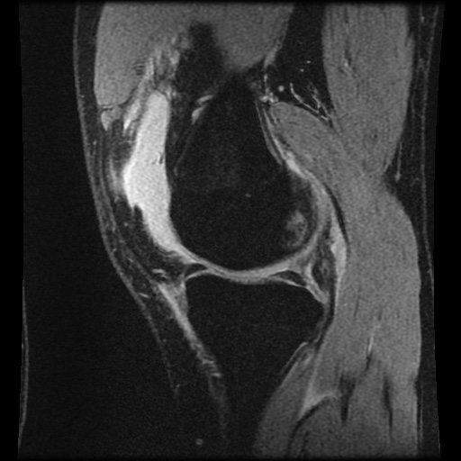 File:Anterior cruciate ligament tear (Radiopaedia 61500-69462 F 25).jpg