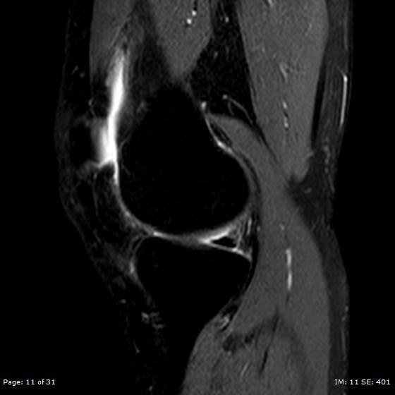 File:Anterior cruciate ligament tear (Radiopaedia 70783-80964 Sagittal STIR 11).jpg