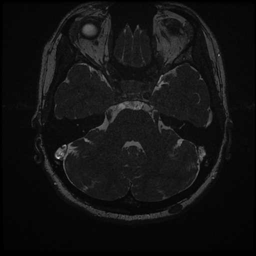 Anterior inferior cerebellar artery vascular loop - type II (Radiopaedia 70991-81209 Axial 3D FIESTA 21).jpg