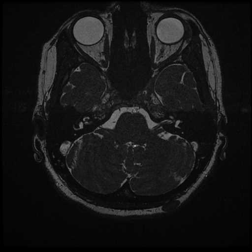 Anterior inferior cerebellar artery vascular loop - type II (Radiopaedia 70991-81209 Axial 3D FIESTA 42).jpg