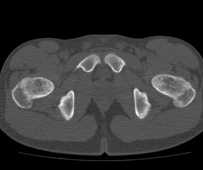 Anterior inferior iliac spine avulsion fracture (Radiopaedia 81312-94999 Axial bone window 63).jpg
