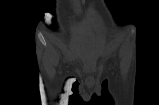 Anterior inferior iliac spine avulsion injury (Radiopaedia 88666-105376 Coronal bone window 12).jpg