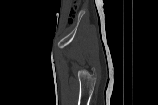 Anterior inferior iliac spine avulsion injury (Radiopaedia 88666-105376 Sagittal bone window 18).jpg