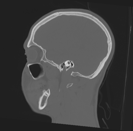 Anterior nasal spine fracture (Radiopaedia 46138-50494 Sagittal bone window 40).png