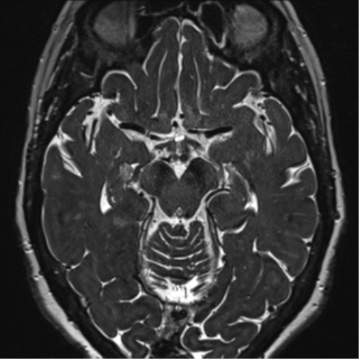 Anterior temporal pole cysts (Radiopaedia 46629-51102 Axial 53).png