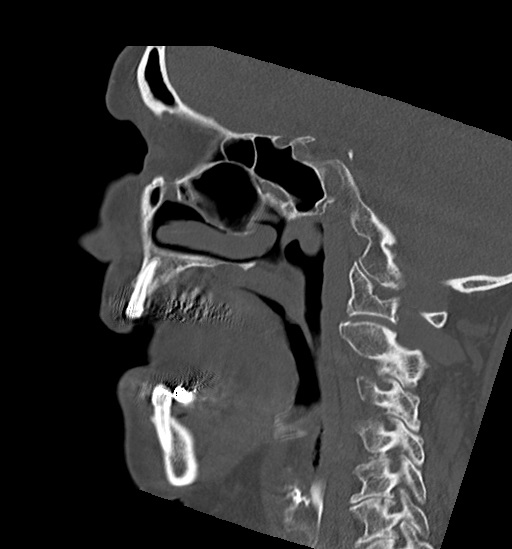 Anterior temporomandibular joint dislocation (Radiopaedia 59430-66784 B 38).jpg